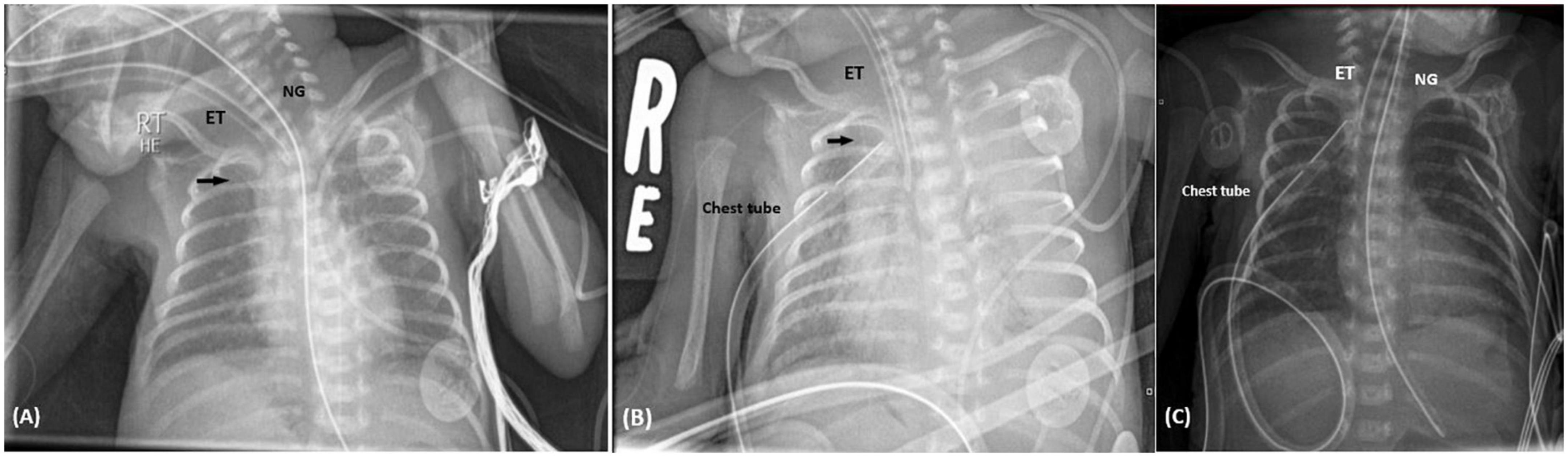 Tamponade and massive pleural effusions secondary to peripherally inserted central catheter in neonates–A complication to be aware of